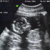 View the image: Ultrasound 11/12/2010