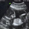 View the image: Ultrasound 11/12/2010