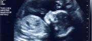 View the Album: Ultrasounds
 3 images